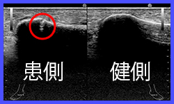 超音波観察