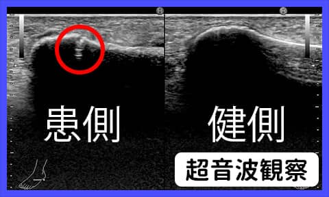 超音波画像