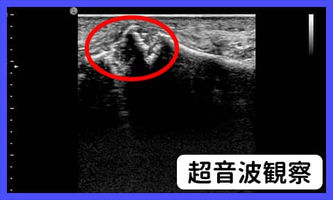 超音波画像