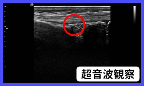 超音波画像