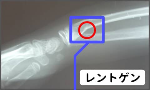 レントゲン