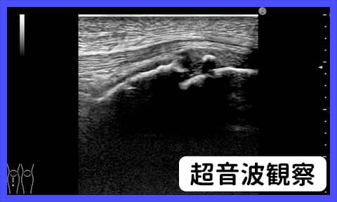 超音波画像